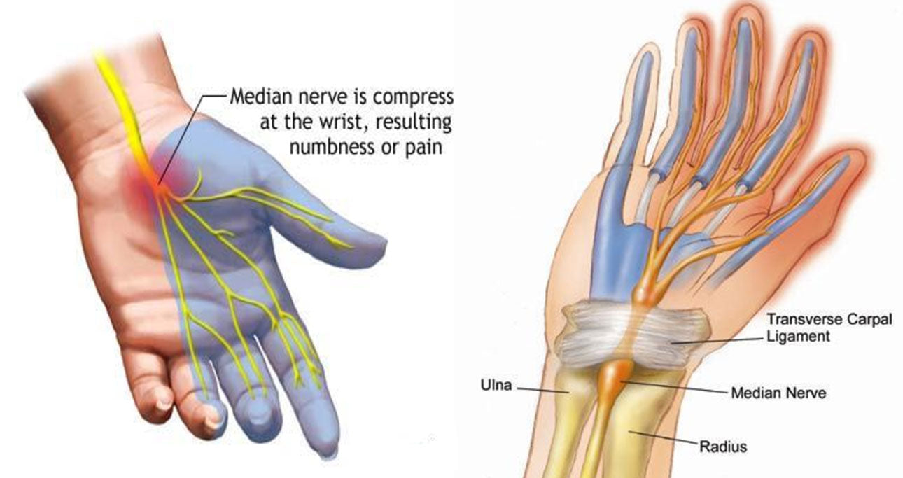 Carpal Tunnel Syndrome - Symptoms & Treatment